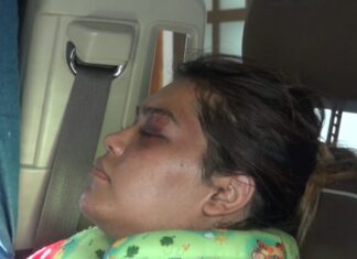 Estefanía, una de las víctimas de mujeres policías de San Miguel de Allende, muestra severas lesiones en rostro y cuerpo.