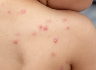 Ya son 9 los casos confirmados de viruela del mono en el estado de Guanajuato.